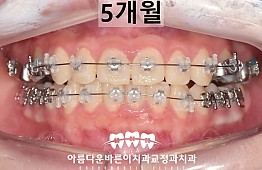 수술후