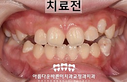 수술전