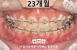 수술후