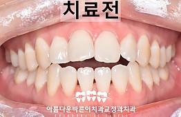 수술전