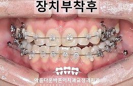 수술후