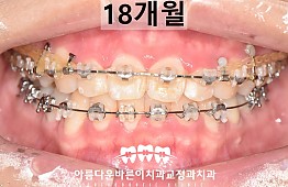 수술후