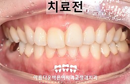 수술전