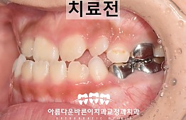 수술전