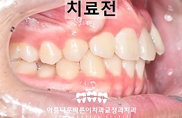 수술전