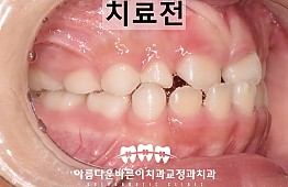 수술전