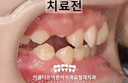 수술전