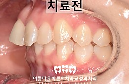 수술전