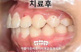 수술후