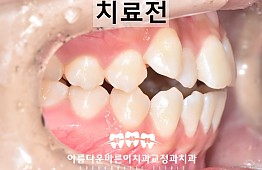 수술전