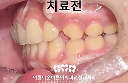 수술전