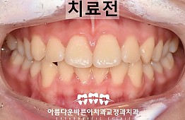 수술전