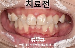 수술전