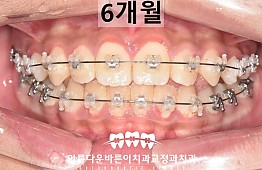 수술후