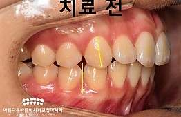 수술전