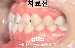 수술전