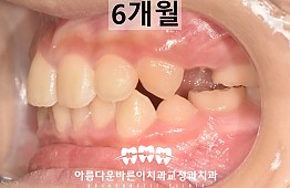 수술후