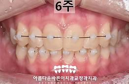 수술후