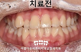 수술전