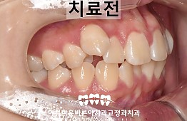 수술전