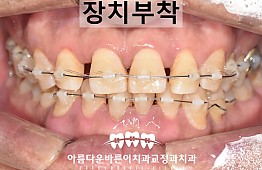 수술후