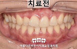 수술전