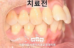 수술전