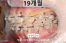 수술후