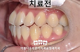 수술전