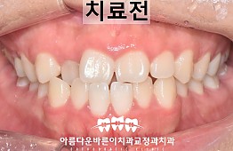 수술전