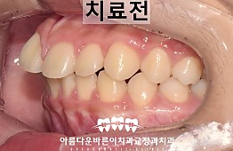 수술전