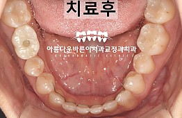 수술후