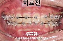 수술전