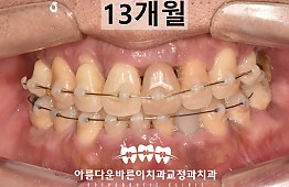 수술후