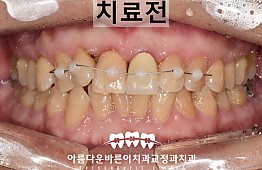 수술전