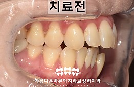 수술전