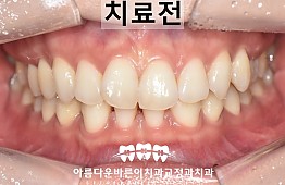 수술전