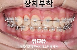 수술후