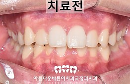 수술전