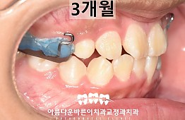 수술후