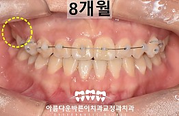 수술후