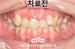 수술전