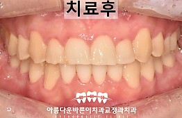 수술후