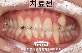 수술전