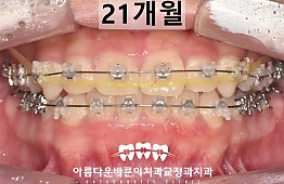 수술후