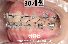 수술후