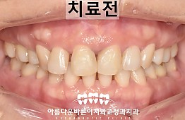 수술전