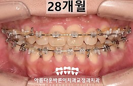 수술후