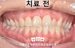 수술전