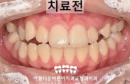 수술전